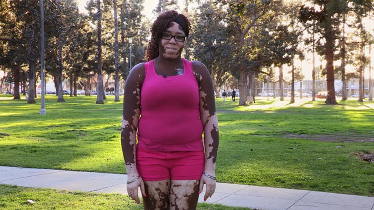 Skin Condition Leaves Woman with Two Skin Colors Body Bizarre