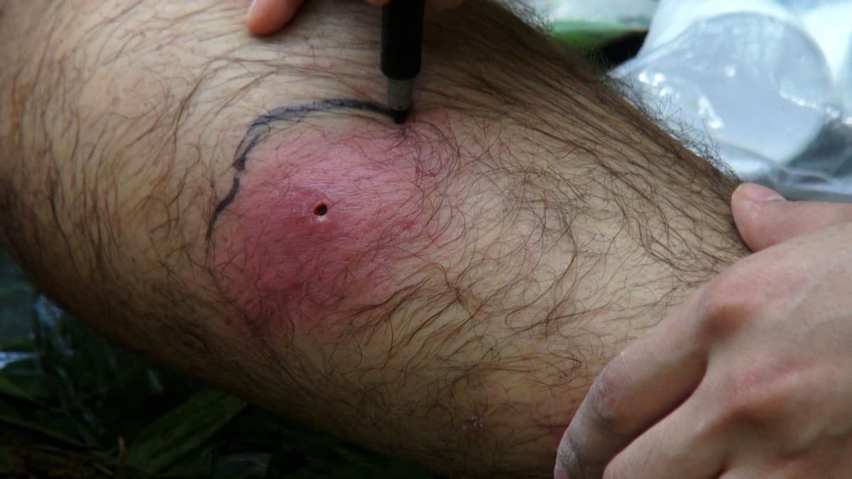 a-badly-infected-tick-bite-naked-and-afraid-discovery