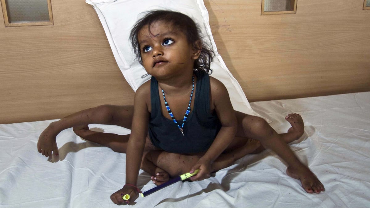 My Baby Has Eight Limbs Body Bizarre