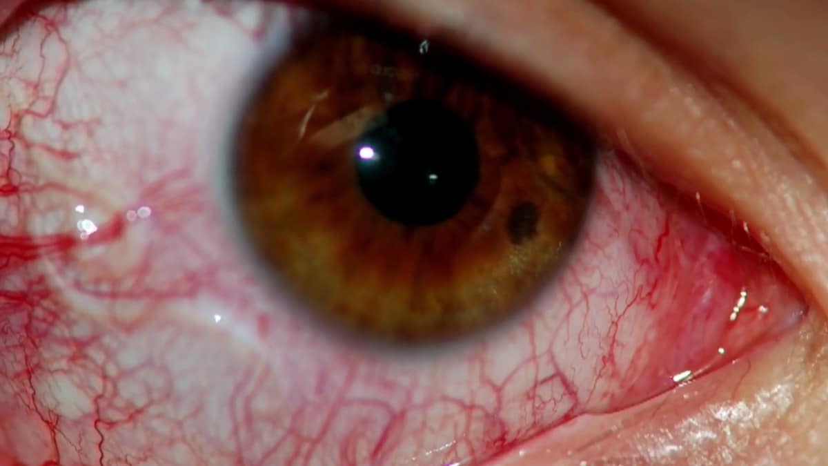 There's a Worm in My Eye Monsters Inside Me