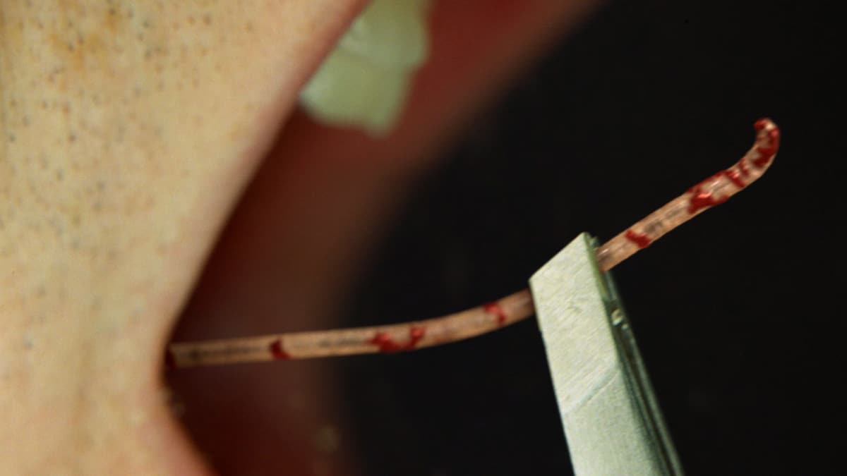 Biologist Removes Parasite from His Own Mouth Monsters Inside Me