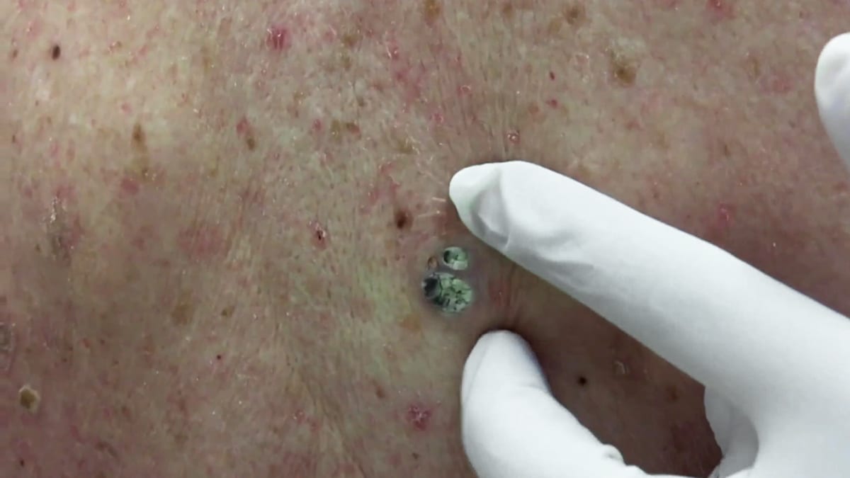 A Dilated Pore Of Winer Dr Pimple Popper This Is Zit