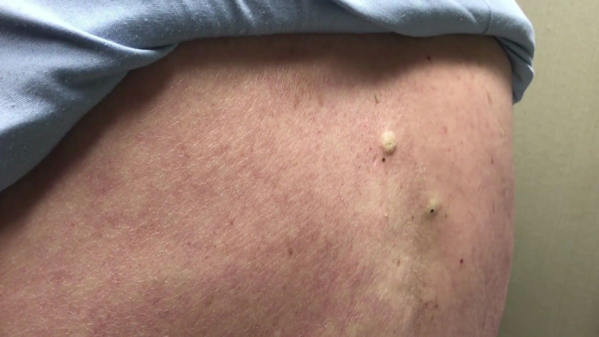 You Saison 2 Episode Total Blackhead Extermination | Dr. Pimple Popper: This is Zit