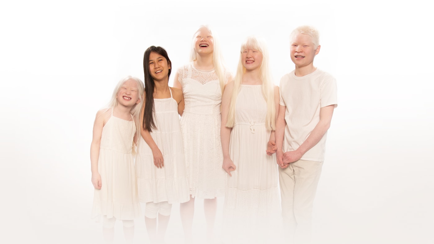 Born With Albinism